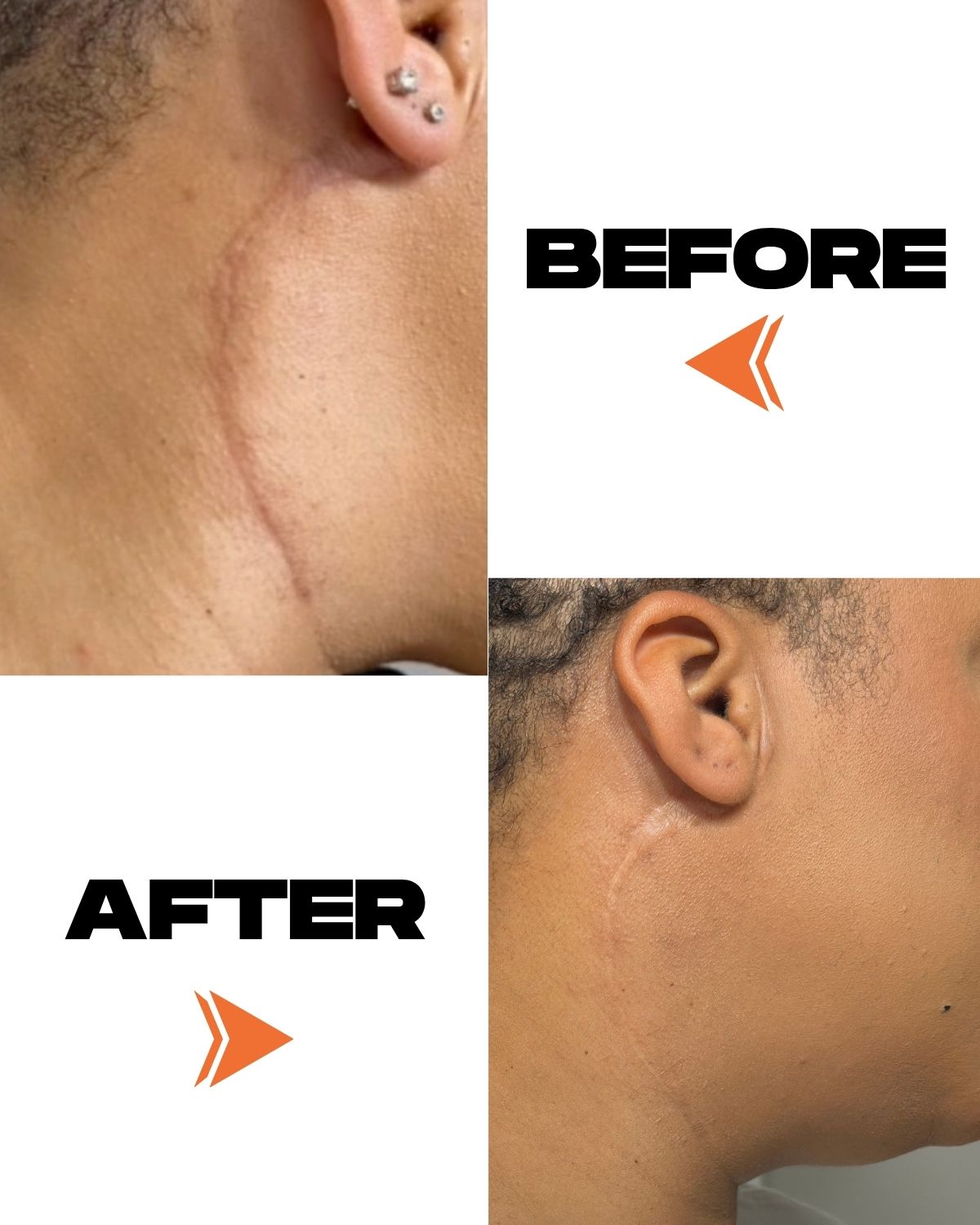 SCAR CREAM - 15ML Motivo Scar Care